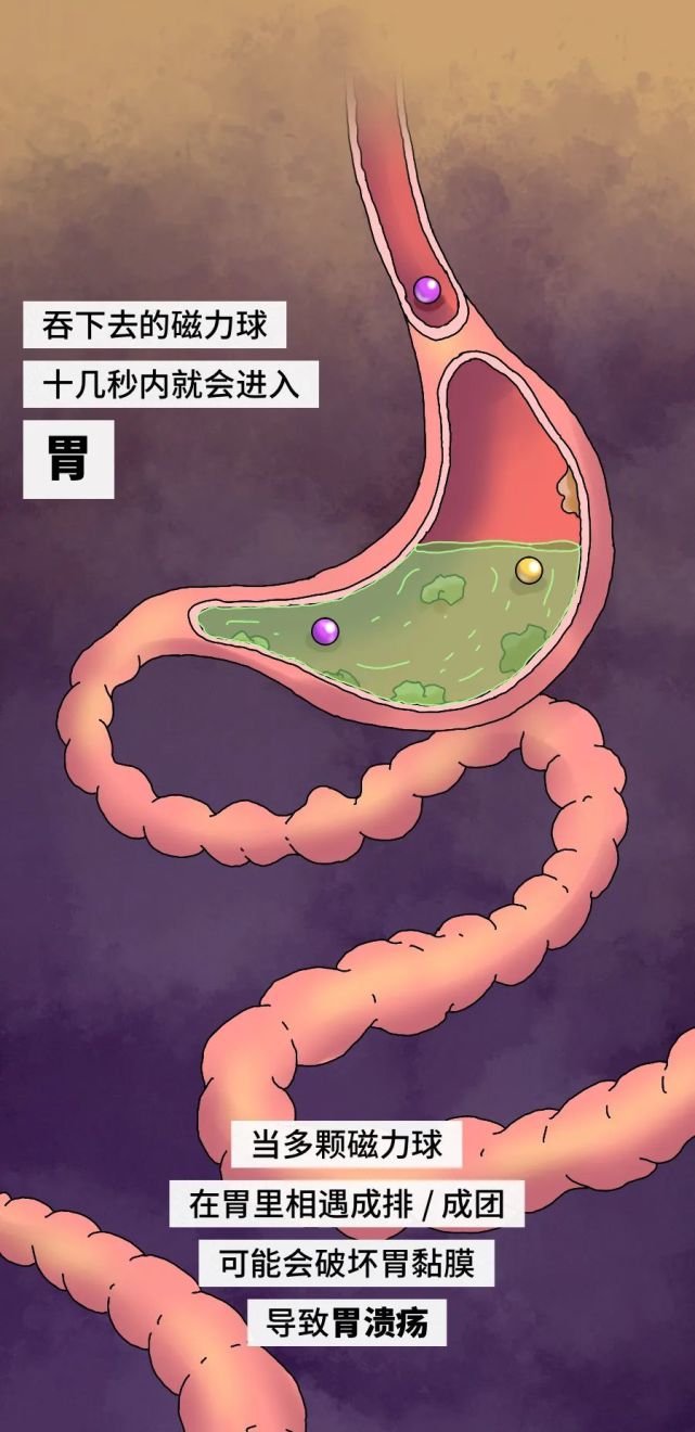 一个男孩吞下了 9 颗磁力球,这是他肠道发生的可怕变化