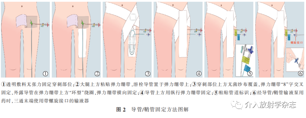 下肢深静脉血栓形成介入治疗护理规范专家共识