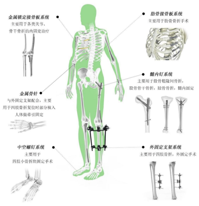 外固定系统主要用于在体外对骨折部位进行固定,通过与金属骨针配合