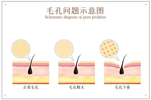 毛孔粗大做什么医美项目比较好 腾讯网