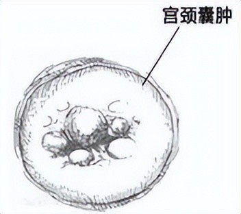 小于3cm的宫颈囊肿可以用药超过5cm需进行物理治疗