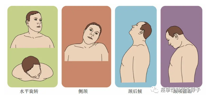 痉挛性斜颈并非绝症如果身体出现这几点症状要小心了