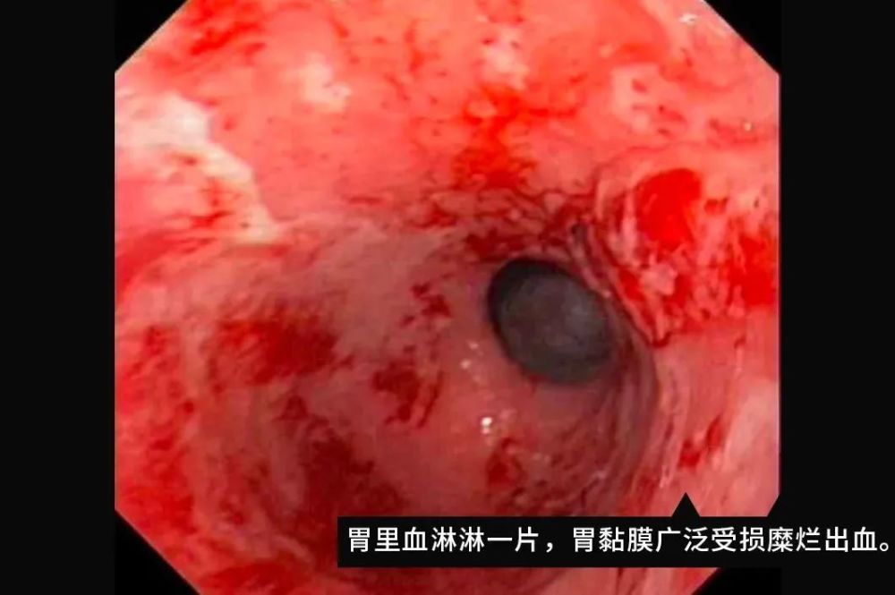 你的胃是怎么坏掉的真实胃镜检查图片揭秘全过程