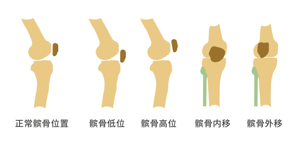 髌骨软化症能治好吗