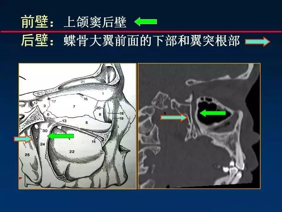 精彩推荐翼腭窝ct解剖图谱