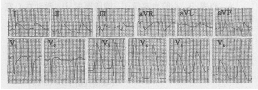 电图虽然没有出现st段的抬高,但是被认为是急性心肌梗死的等危心电图