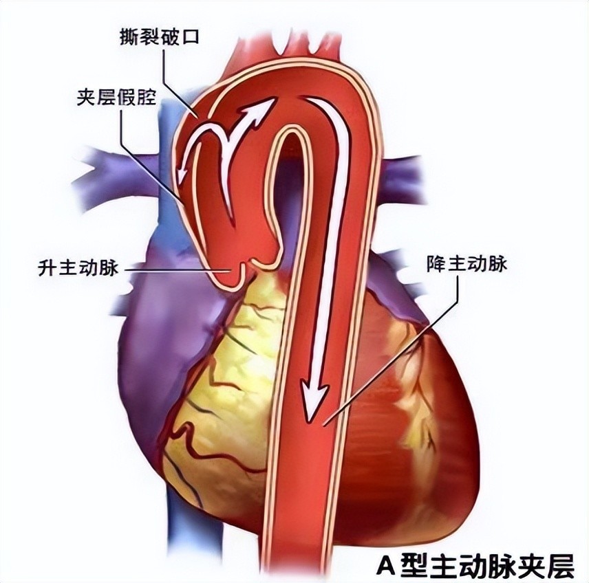 湘雅二医院心血管外科一周完成15例急性a型主动脉夹层手术