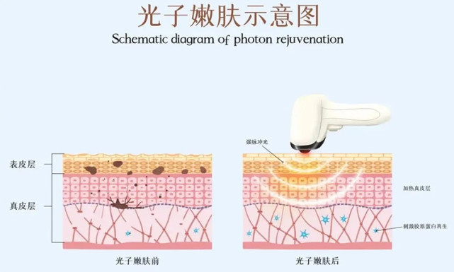 【杭州艺星】光子嫩肤技术可以治疗哪些皮肤病变?及其效果?