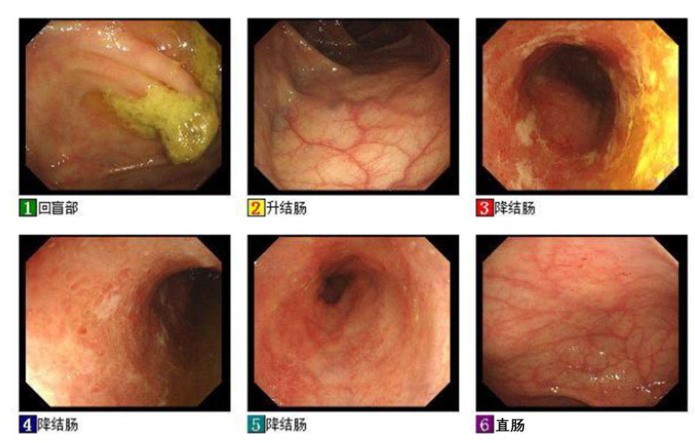 医院)溃疡性结肠炎(e2,mayo 3分(图1;结核感染t细胞斑点试验(t-spot