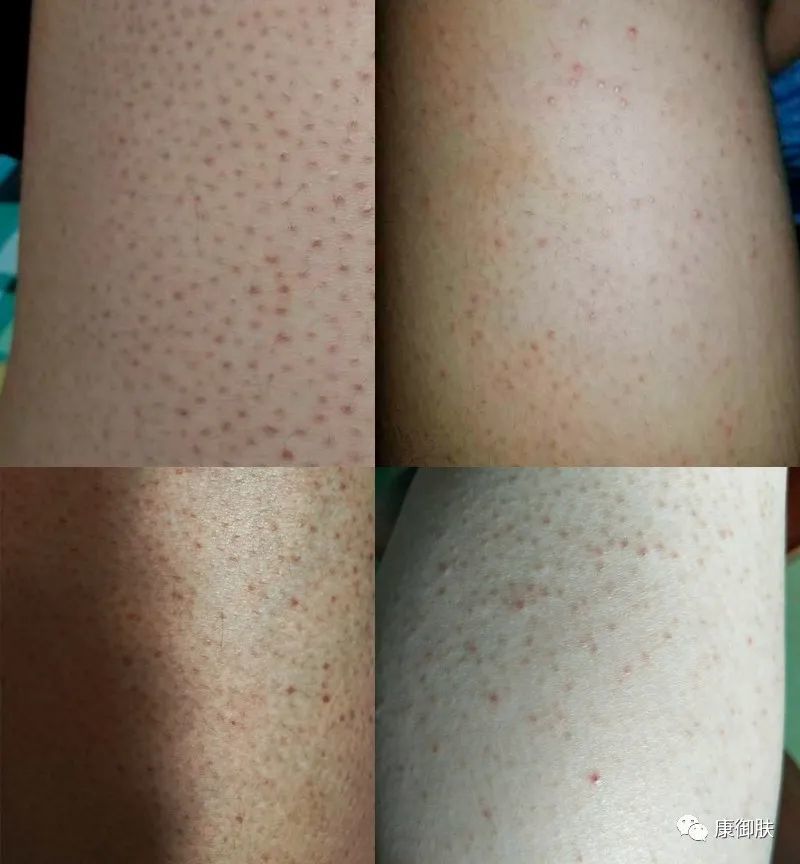 毛囊炎还是鸡皮肤区别图片的简单介绍