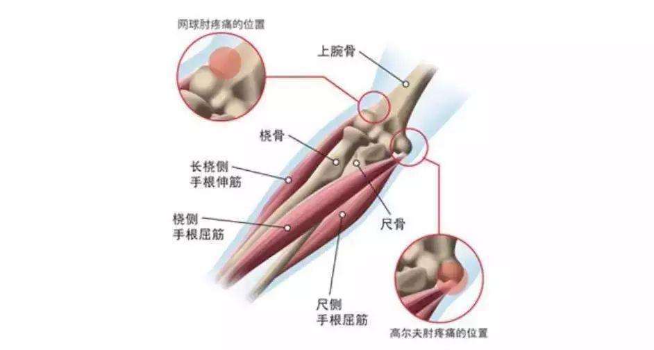 網(wǎng)球肘外用藥有哪些