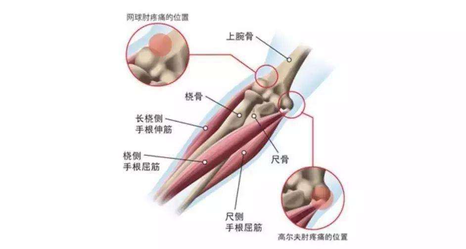 网球肘外用药有哪些