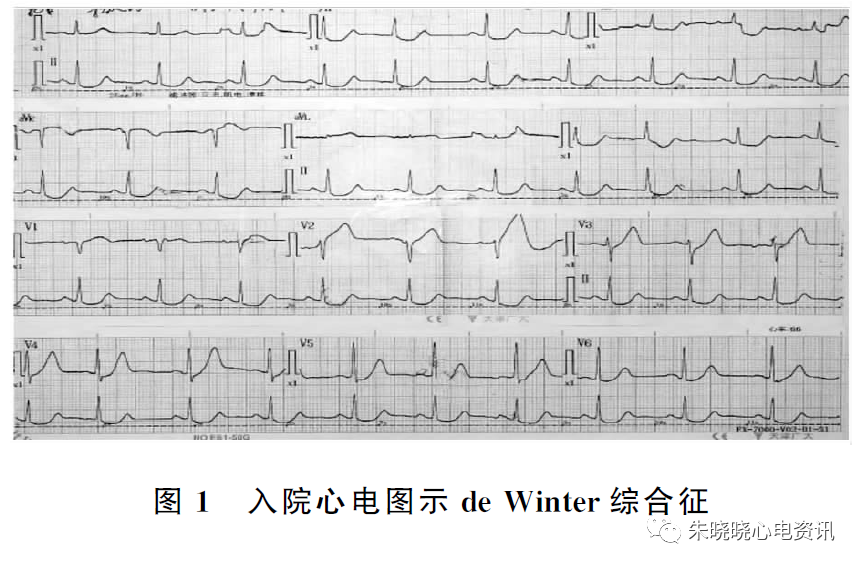 动态演变的dewinter综合征并发室颤文献复习