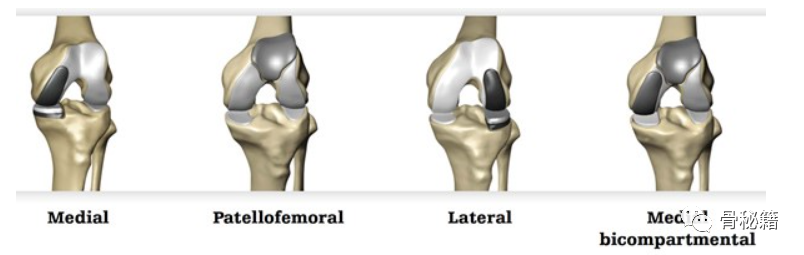 膝关节已经逐渐从万金油全膝置换逐渐向更精准的部分置换逐渐发展支持