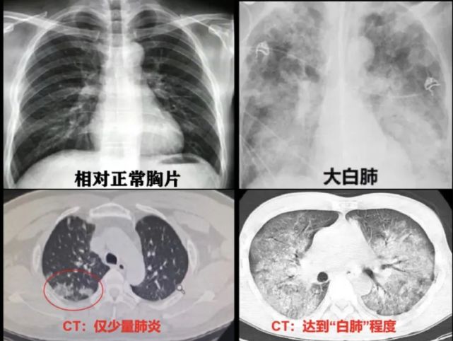 Ct影像出现“白色”就是“白肺”？重型肺炎预警信号有哪些？ 腾讯新闻