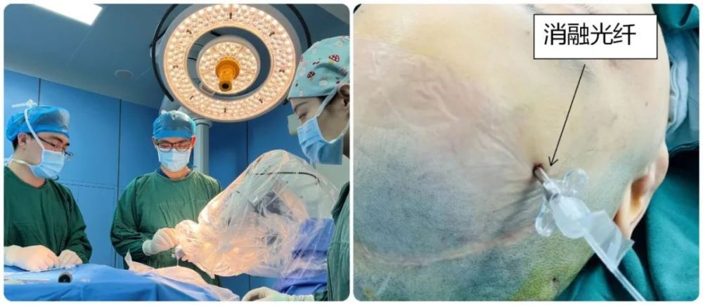 华科在线｜福医附一院完成省内第一例脑胶质瘤LITT手术