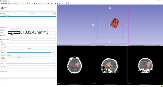 快速微创！3d Slicer辅助内镜治疗高血压脑出血腾讯新闻eow 0748