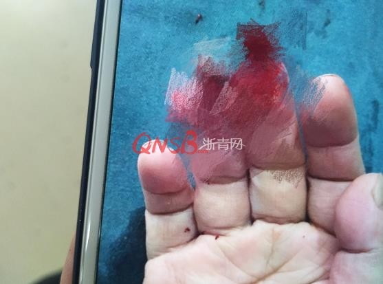 萧山一大姐用手挡了下门 被夹断两根手指