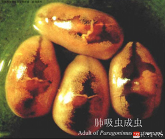 深圳女子感觉肚子有虫爬 行剖宫产术取出2cm