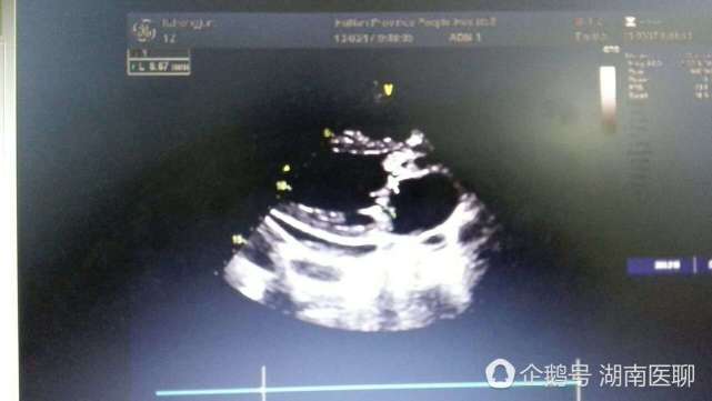 长沙女大学生反复高烧下肢水肿 心脏被细菌 吞