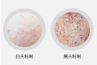 痘痘闭口总是没完没了?你的水乳、防晒都有问