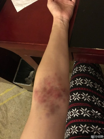 胡静南方拍戏湿气入侵 胳膊上湿疹有点吓人_移
