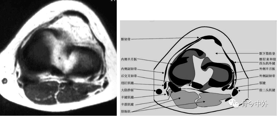 膝关节mr解剖(横断面 是三维影像首选的方位,也是为了便于mri与ct