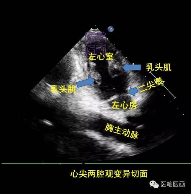 心尖两腔观变异切面