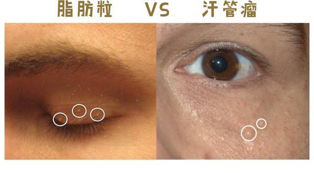 小颗粒脂肪粒一般是指「粟丘疹」首先让我们了解一下,什么是脂肪粒?