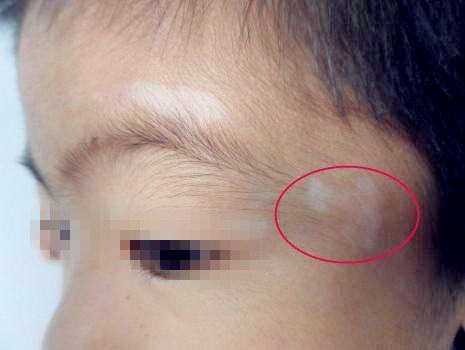 孩子这6个症状,就是肚子长了蛔虫