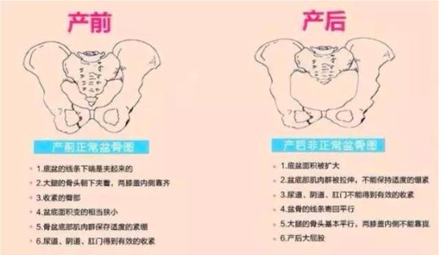 盆底康复治疗方案全汇总一套产后康复操教你正确康复
