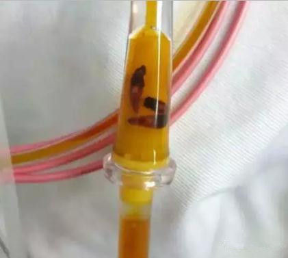 火炬区超两成人群感染肝吸虫