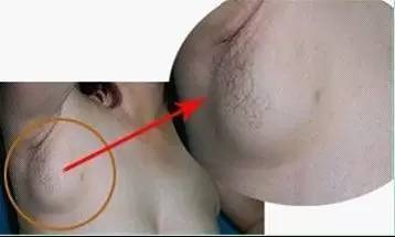 副乳只是腋下的两坨赘肉细数副乳的10大危害