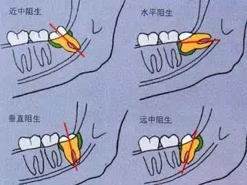 能容下28颗牙齿已经差不多了,没有更多的空间留给最晚萌出的智齿
