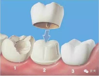 刘涛崩溃的告诉大家:牙齿美白千万不要学她!