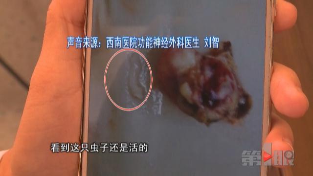 虫子在女子脑袋里生活4年 被活捉出来