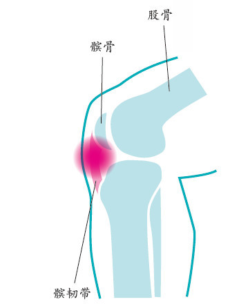 髌骨关节疼痛综合征(跑步膝)