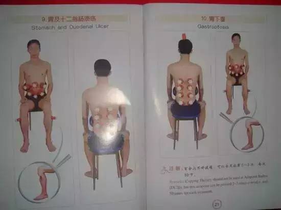 (图解拔火罐穴位)