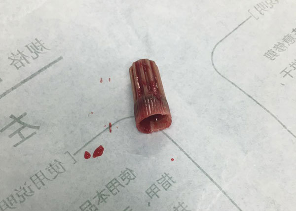 9岁女孩隐私部位瘙痒6年 医生从中取出2厘米长