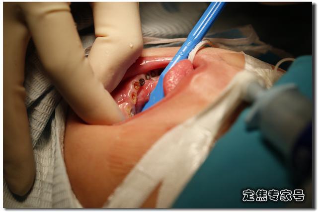 一个小习惯,4岁孩子的13颗牙齿全拔了