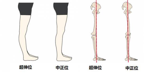 那手肘/膝盖超伸形成的原因究竟是什么呢?