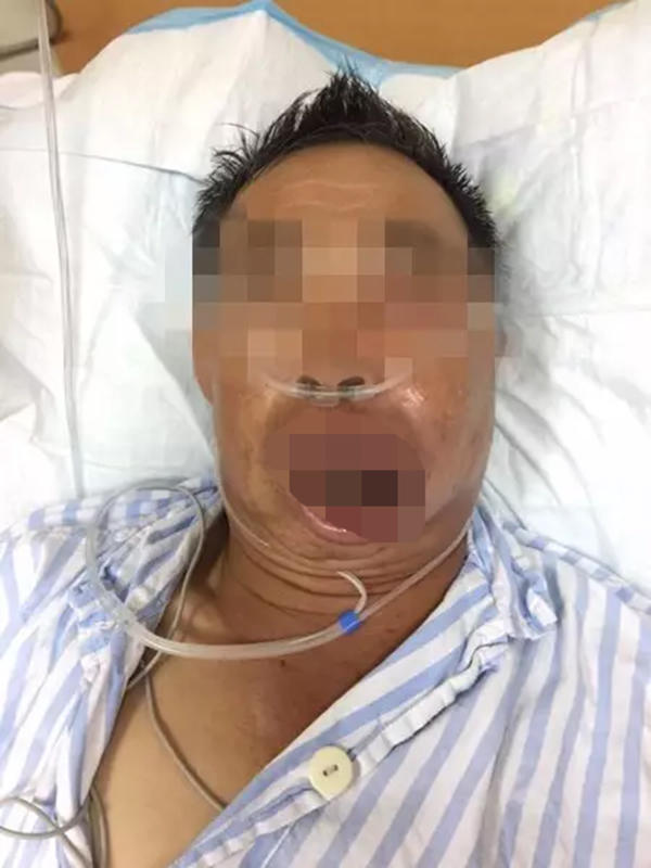 男子擠破一顆痘 醫(yī)生連下兩次病危通知書(shū)