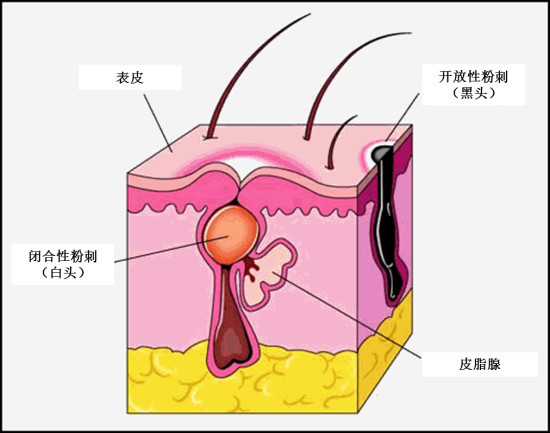 50岁大叔挤痘痘险丧命,痘痘为什么不能随便挤