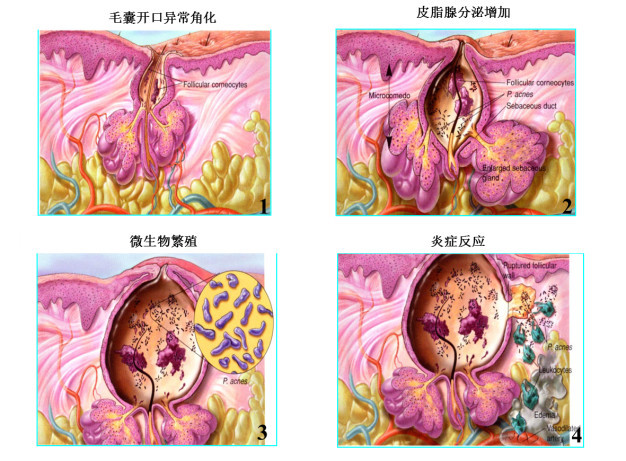 50岁大叔挤痘痘险丧命,痘痘为什么不能随便挤