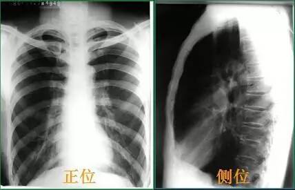x线表现:两肺透亮度增加;肺纹理变细,稀疏;胸廓呈桶状,肋间隙增宽