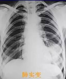 肺实变:灶性,肺段,大叶或一侧肺,肺泡内的气体被渗出物代替而形成肺