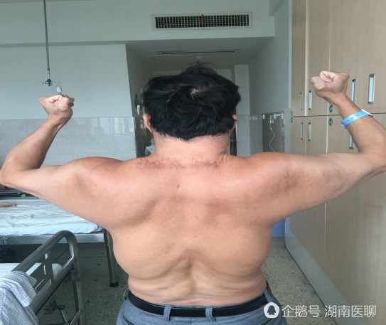 永州男子日饮半斤白酒 喝出河马脖身型似超