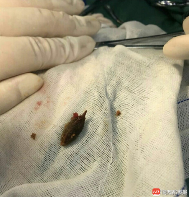 珠海1岁宝宝误吞枣核 导致小肠穿孔险丢命