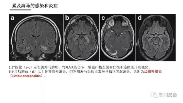 海马正常解剖与疾病影像诊断