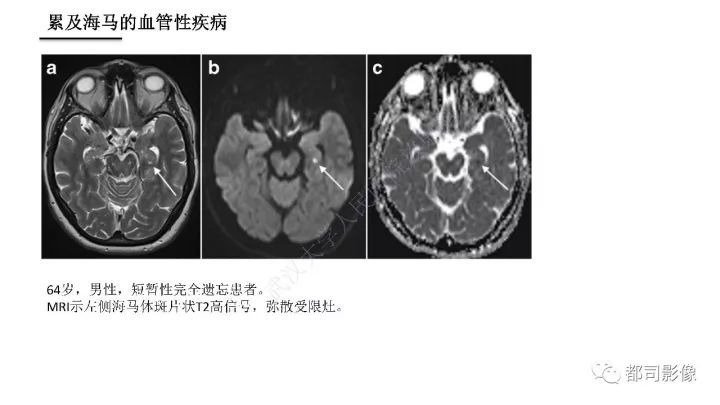 海马正常解剖与疾病影像诊断